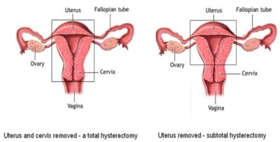 Laparoscopic Hysterectomy And Assisted Vaginal Hysterectomy