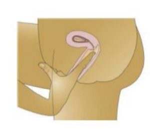 Advice following your coil insertion Buckinghamshire Healthcare NHS Trust