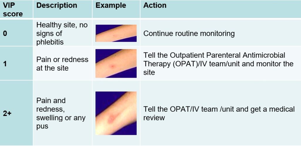 Peripheral intravenous (IV) midline catheter (adults only ...